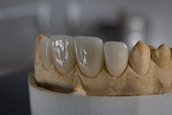 corone in zirconio