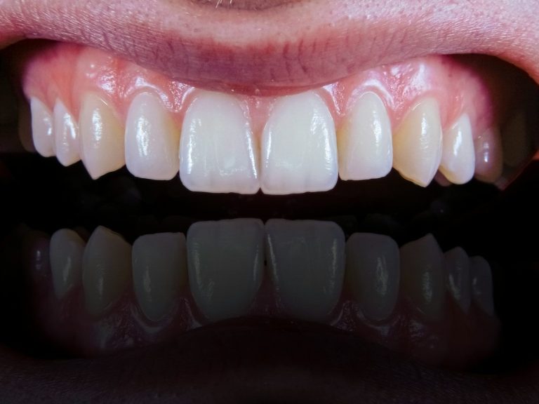 denti bianchi sbiancamento dentale